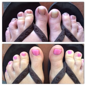 Creative Nails - My hideous toes before and after. No more shame - Nail Salons Near Me - Santa Barbara, California Creative Nails - My hideous toes before and after. No more shame - Nail Salons Near Me - Santa Barbara, California