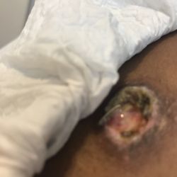 Academic Alliance in Dermatology - South Tampa - Infection