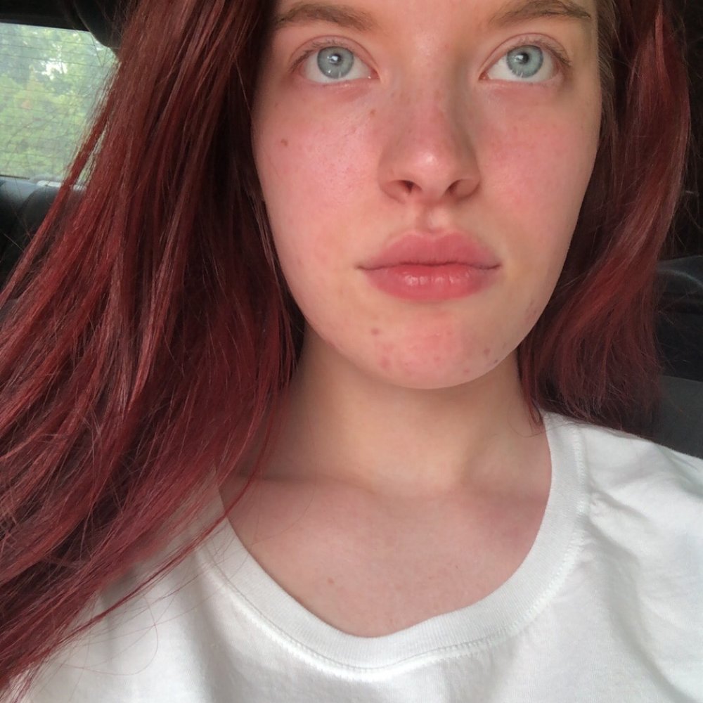 LaBella Skinbar - My skin after an acne facial in normal lighting! - Waxing Near Me - Germantown, Tennessee LaBella Skinbar - My skin after an acne facial in normal lighting! - Waxing Near Me - Germantown, Tennessee