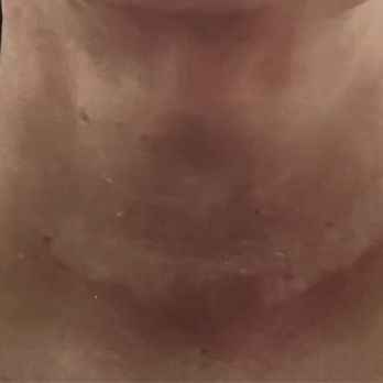 Restore Plastic Surgery - Permanent hypopigmentation - Cosmetic Surgeons Near Me - Pensacola, Florida