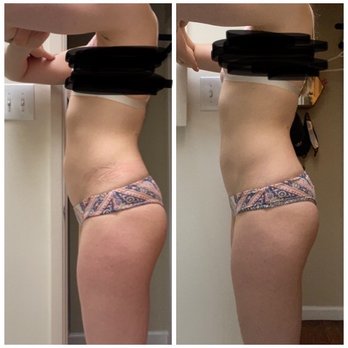 Shahin Javaheri, MD - Before (l) after (r) 6 vanquish sessions. 1 month after last session. - Cosmetic Surgeons Near Me - San Francisco, California