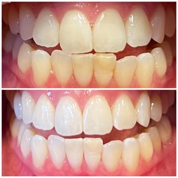 Deebeaut - Before and after - Teeth Whitening Near Me