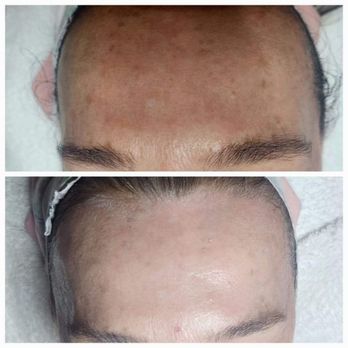 Surf City Skin Care - Cryotherapy Facial one treatment. - Skin Care Near Me - St. John's, Florida Surf City Skin Care - Cryotherapy Facial one treatment. - Skin Care Near Me - St. John's, Florida