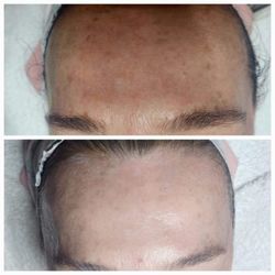 Surf City Skin Care - Cryotherapy Facial one treatment.