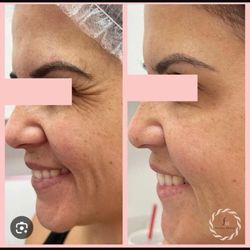 Facial Mania - BEFORE AND AFTER 

BOOK YOUR NOW!
