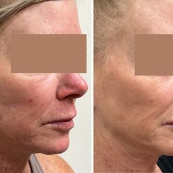FlashLaser Aesthetics - Before 1st & after a series of 3 Potenza Radio Frequency Microneedling treatments for face and neck