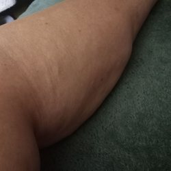 The Center of Regenerative Medicine - This is the right it was not worked on but reaped all the Benefits. Next week right leg.