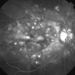 California Retina Consultants