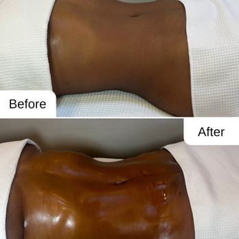 Love Curves - before and after lymphatic drainage massage - Body Contouring Near Me - Whittier, California Love Curves - before and after lymphatic drainage massage - Body Contouring Near Me - Whittier, California