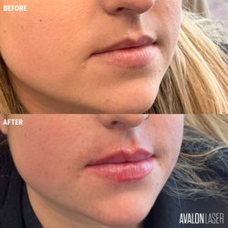 Avalon Laser - Lip Filler | Client received .5 syringe of Restylane Kysse. (Side View)