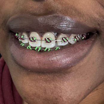 Hodson & Meister - Cool braces colors - Orthodontists Near Me - North Miami Beach, Florida Hodson & Meister - Cool braces colors - Orthodontists Near Me - North Miami Beach, Florida