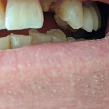 Benitez Dental Clinic - Filed down a good tooth. Crown broke. Now I need an implant. - General Dentistry Near Me - Nuevo Progreso, TAM Benitez Dental Clinic - Filed down a good tooth. Crown broke. Now I need an implant. - General Dentistry Near Me - Nuevo Progreso, TAM