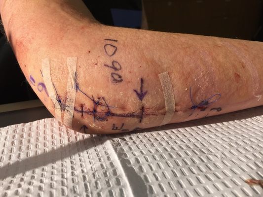 Bellevue Hand Surgery