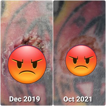 Oregon Cosmetic & Reconstructive Clinic - You can see the poor stitching around the edge that left me looking abnormal. - Cosmetic Surgeons Near Me - happy valley, Oregon