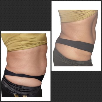lipo-c injections staten island Kybella Island, NY It's Here!! Lipotropic B-12