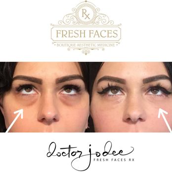 Fresh Faces Rx - Undere eye PRF - Medical Spas Near Me - Portland, Oregon Fresh Faces Rx - Undere eye PRF - Medical Spas Near Me - Portland, Oregon