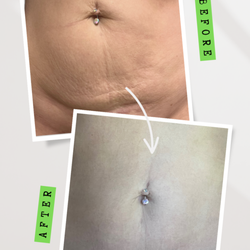 The Skin Perfector - Stretch mark Revision and Belly button Retraction