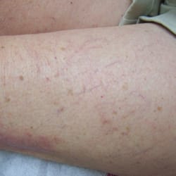 Capitol Vein & Laser Centers - After Sclerotherapy treatment for spider veins.