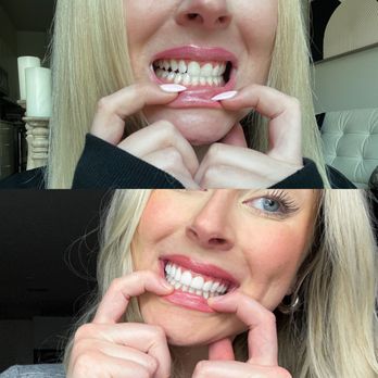 The Hills Dental Spa - Before and After Porcelain Veneers at The Hills Dental Spa in Austin, Texas - General Dentistry Near Me - Austin, Texas The Hills Dental Spa - Before and After Porcelain Veneers at The Hills Dental Spa in Austin, Texas - General Dentistry Near Me - Austin, Texas