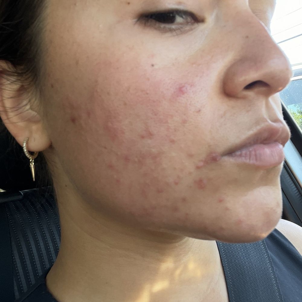 Face First Skin Care - My skin when I first started getting facials with Erika - Skin Care Near Me - Los Angeles, California Face First Skin Care - My skin when I first started getting facials with Erika - Skin Care Near Me - Los Angeles, California