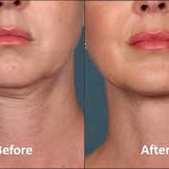 Sereno Aesthetics - Kybella before and after - Medical Spas Near Me - Los Gatos, California Sereno Aesthetics - Kybella before and after - Medical Spas Near Me - Los Gatos, California