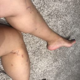 Bedbug bites!