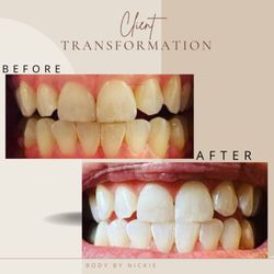 Body By Nickie - Teeth whitening