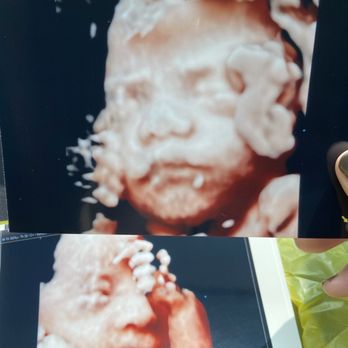3D-4D Ultrasound Studio Queens - Printed HD photos of babies face. - Diagnostic Imaging Near Me - Flushing, New York