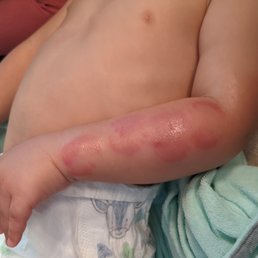 They allowed a known biter to play with my child unsupervised. They allowed a known biter to play with my child unsupervised.