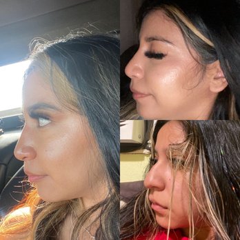 Roger Tsai, MD - Before lower right After 1 month upper right After 4 months left side - Cosmetic Surgeons Near Me - West Hollywood, California Roger Tsai, MD - Before lower right After 1 month upper right After 4 months left side - Cosmetic Surgeons Near Me - West Hollywood, California