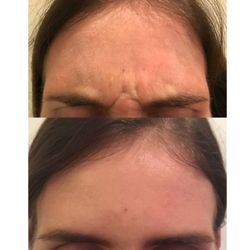 Daniel Butz, MD - Before/After - 2 weeks after 60U Dysport