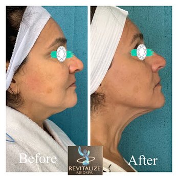 Revitalize Medspa - Before and After 2 Morpheus8 micro needing with radio frequeny treatments - Medical Spas Near Me - New Braunfels, Texas Revitalize Medspa - Before and After 2 Morpheus8 micro needing with radio frequeny treatments - Medical Spas Near Me - New Braunfels, Texas
