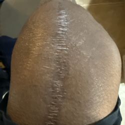Memorial Hermann Medical Plaza - The scar from my knee replacement