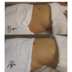 Balanced Pro Massage - Chino Hills - These are the results from one session of Manual Lymphatic Drainage Massage. We currently have two MLD therapists on staff.