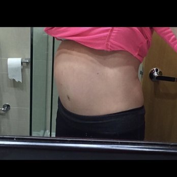 Mark Sisco, M.D - I look pregnant horrible - Cosmetic Surgeons Near Me - Northbrook, Illinois