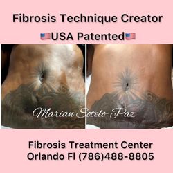 Restorative Therapeutics Clinic - Fibrosis after liposuction treatment by Marian Sotelo-Paz