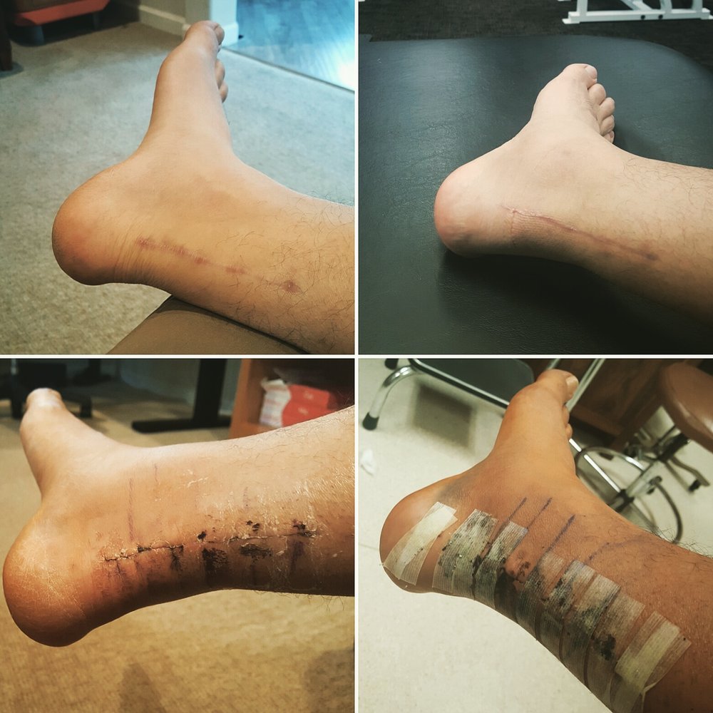 Eugene DellaMaggiore ,MD - Healing progression of achilles rupture repair over the span of 5 months. Top left image is most recent. - Sports Medicine Near Me - San Jose, California Eugene DellaMaggiore ,MD - Healing progression of achilles rupture repair over the span of 5 months. Top left image is most recent. - Sports Medicine Near Me - San Jose, California