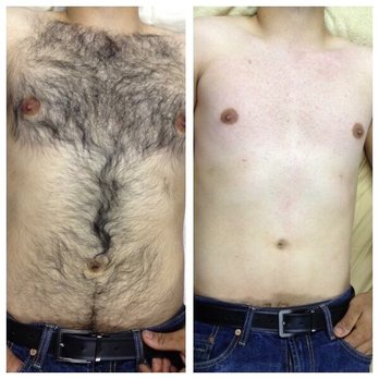 Your Body's ReTreat - Chest sugaring! Before and after. - Skin Care Near Me - Hurst, Texas Your Body's ReTreat - Chest sugaring! Before and after. - Skin Care Near Me - Hurst, Texas