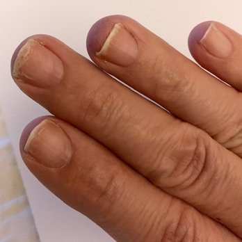 Redmond Ridge Nails - Finished antibiotics. You can see that my R hand also had something going on with my finger next to the pinkie. Forming a crust under nail. - Nail Salons Near Me - Redmond, Washington Redmond Ridge Nails - Finished antibiotics. You can see that my R hand also had something going on with my finger next to the pinkie. Forming a crust under nail. - Nail Salons Near Me - Redmond, Washington