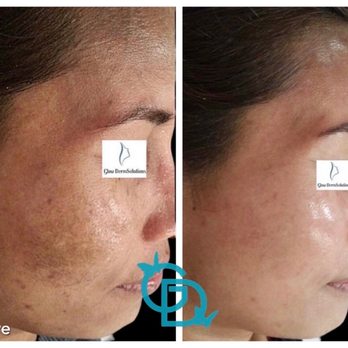 Glow DermSolutions - Before after for hyperpigmentation and rejuvenation - Medical Spas Near Me - San Jose, California Glow DermSolutions - Before after for hyperpigmentation and rejuvenation - Medical Spas Near Me - San Jose, California
