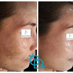Glow DermSolutions - Before after for hyperpigmentation and rejuvenation