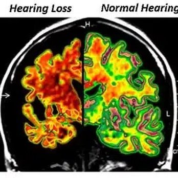 The Hearing Aid Store - See how addressing hearing loss ensures maximum brain activity. - Hearing Aid Providers Near Me - Albuquerque, New Mexico