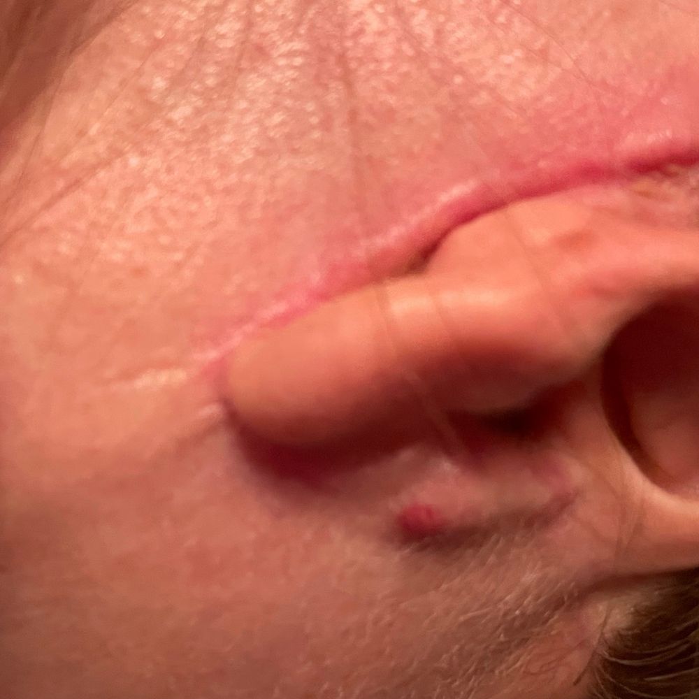 CosMed - Dr Quiroz left me this scars - Cosmetic Surgeons Near Me - Tijuana, BCN