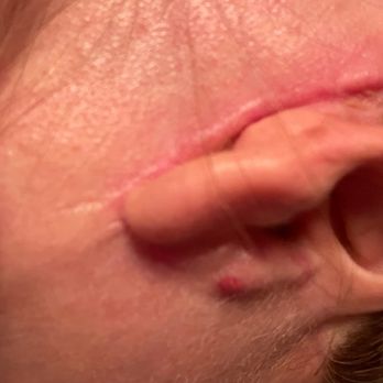 CosMed - Dr Quiroz left me this scars - Cosmetic Surgeons Near Me - Tijuana, BCN