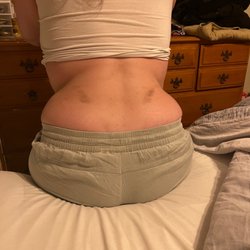 Buffalo Spine & Sports Medicine - See bruises here that I mentioned in my review.