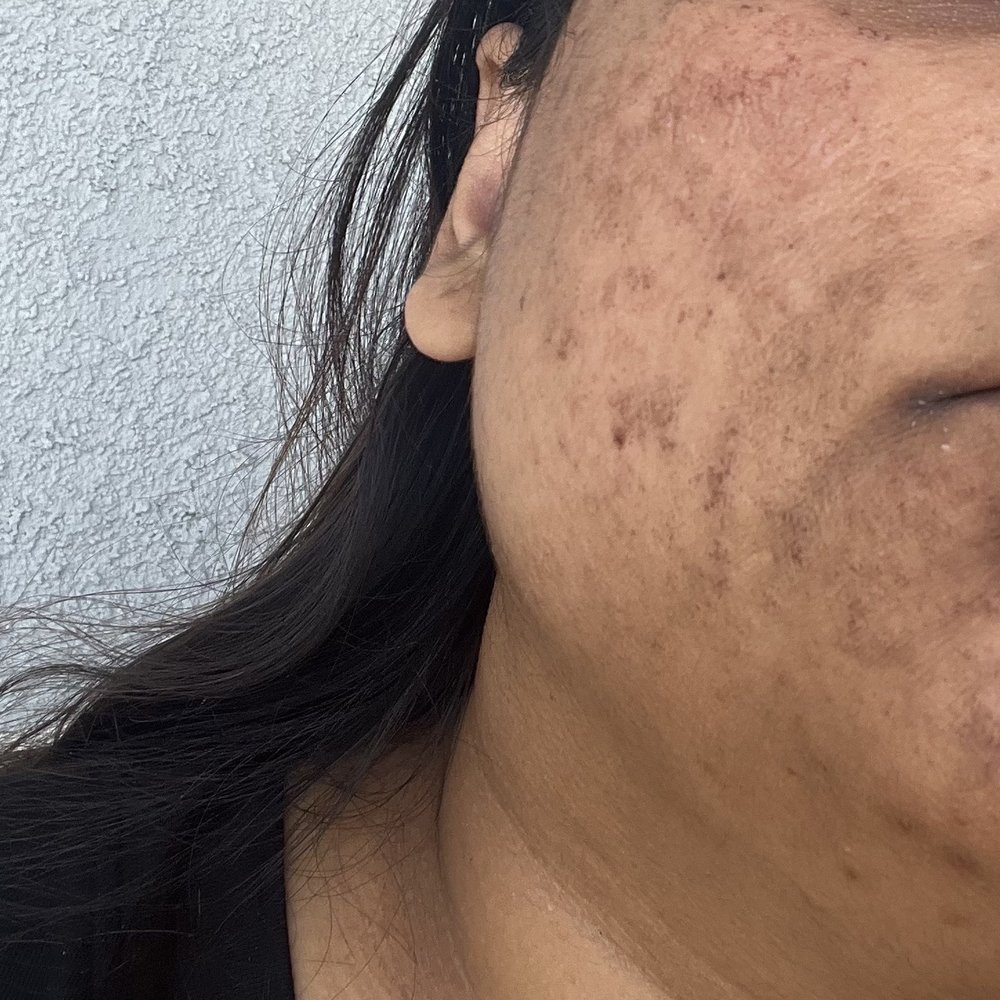 Lash Vibe - face and chin injured - Skin Care Near Me - Rancho Cordova, California Lash Vibe - face and chin injured - Skin Care Near Me - Rancho Cordova, California