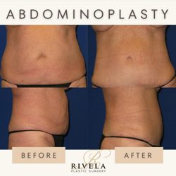 Rivela Plastic Surgery - Abdominoplasty at Rivela Plastic Surgery