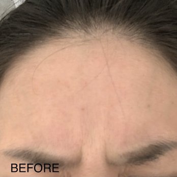 Elevate Smile Design - Frown line before - General Dentistry Near Me - Spanaway, Washington