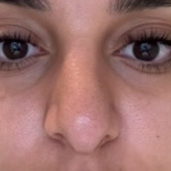 Ramly Plastic Surgery - Before: My nose after my first rhinoplasty with another doctor - Plastic Surgeons Near Me - Beverly Hills, California Ramly Plastic Surgery - Before: My nose after my first rhinoplasty with another doctor - Plastic Surgeons Near Me - Beverly Hills, California