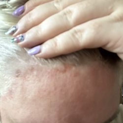 The spots along my hair line were popped blisters.